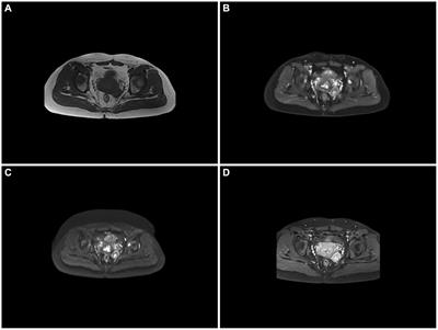 Case report: Solitary fibrous tumor of the paracervical uterus combined with vaginal wall adenocarcinoma